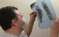 Примусове лікування хворих на туберкульоз – це вимушений, але результативний захід